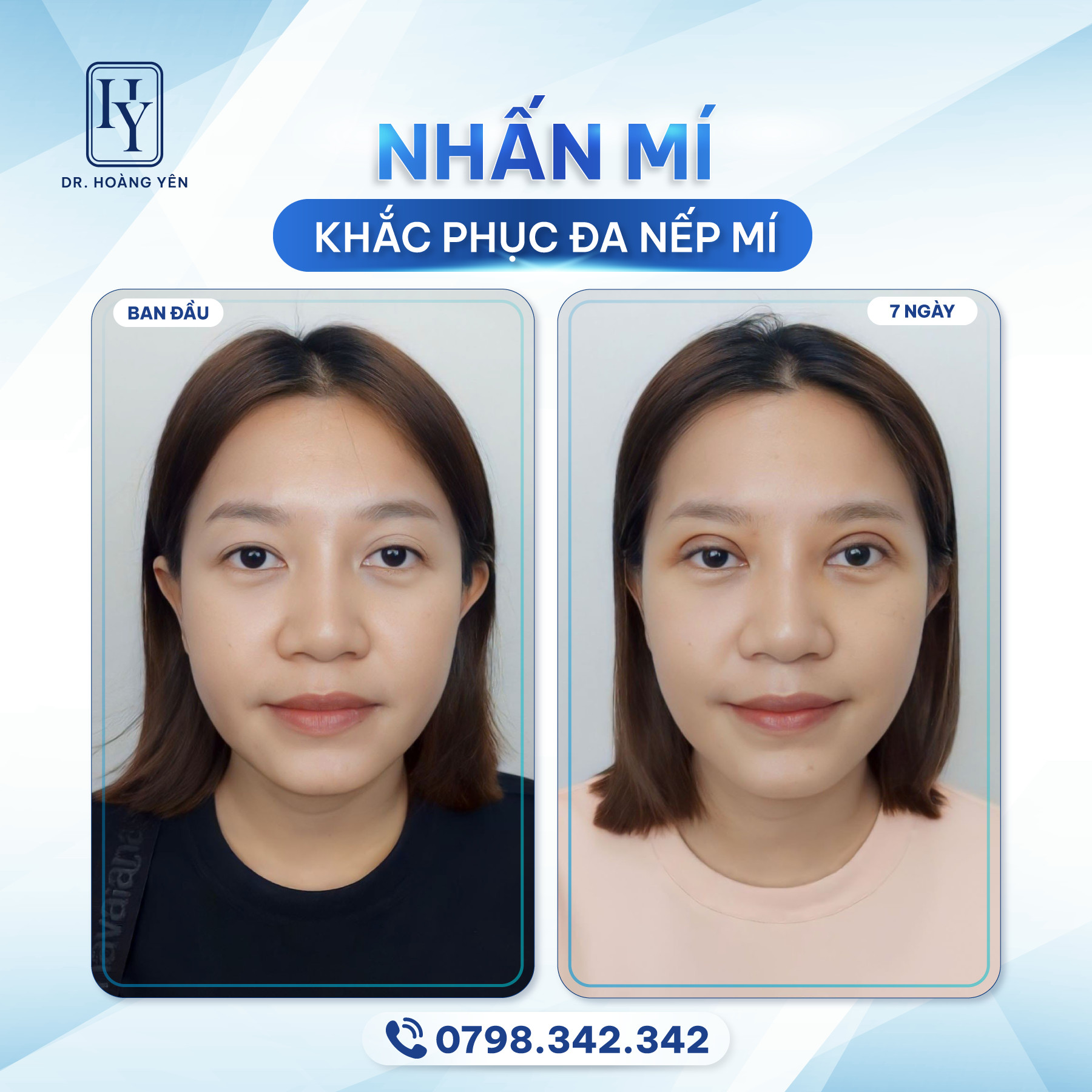 Thay đổi sau nhấn mí